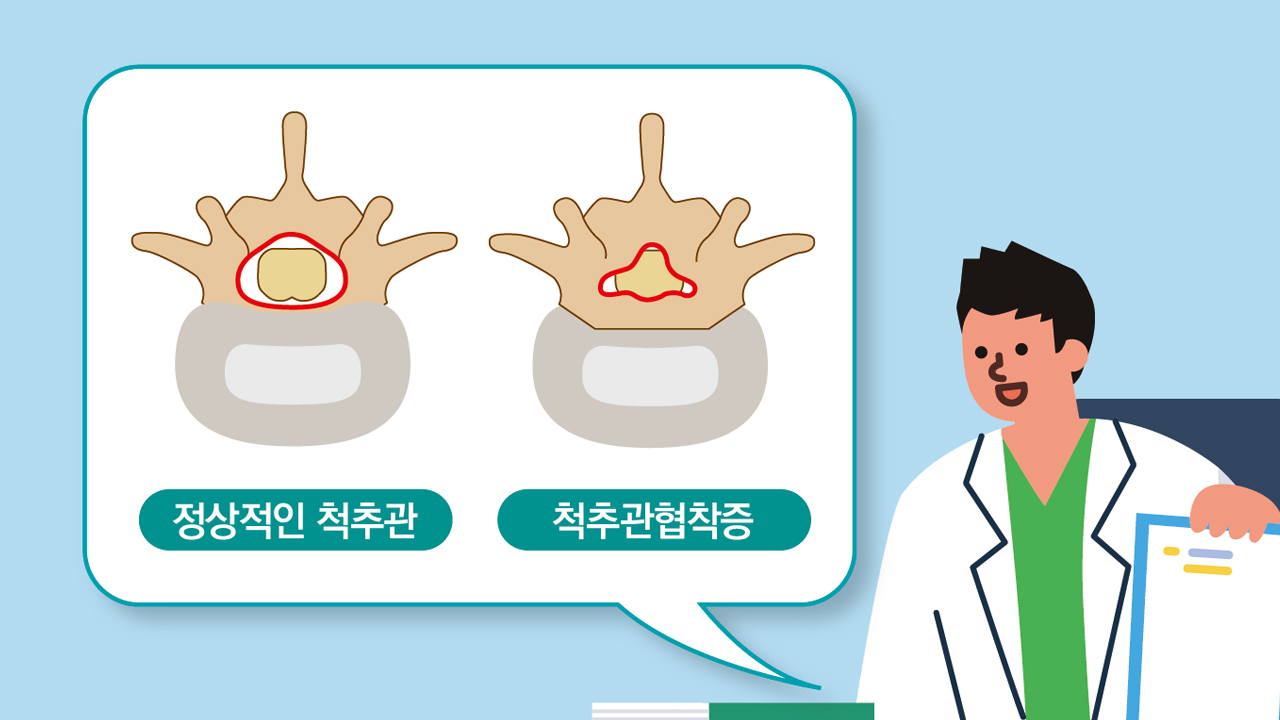 조금만 걸어도 허리와 다리가 아파요! 척추관협착증